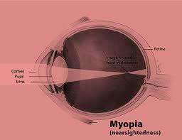 Science Class 10 Human Eye and Colourful World Myopia